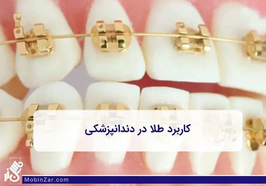 استفاده از طلا در صنعت پزشکی و دندانپزشکی یکی از گزینه های مناسب کاربرد طلا است.